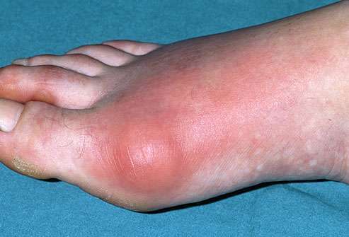 Close-up of a foot with swelling and redness, indicating joint inflammation. The skin appears taut and slightly shiny, suggesting irritation or infection. A dietitian might recommend plant-based remedies to support healing. The foot rests on a blue fabric background.